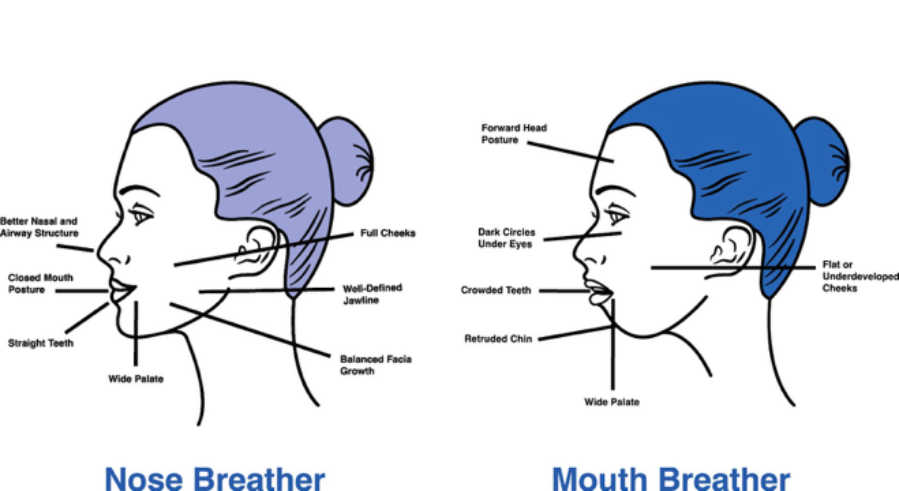 When Behaviour Speaks: How Chiropractic Helps Children Move Towards Calm, Focus & Regulation 4 Mouth Breather