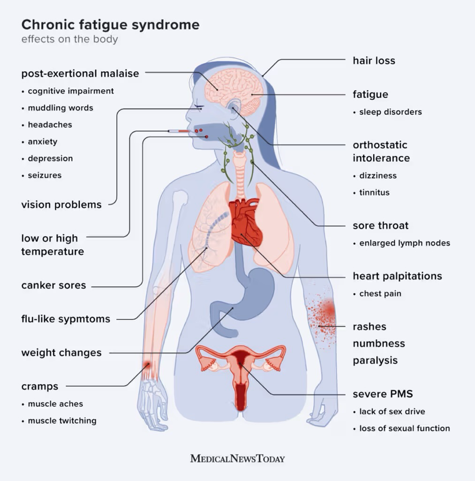 Diagram depicting Chronic Fatigue Syndrome