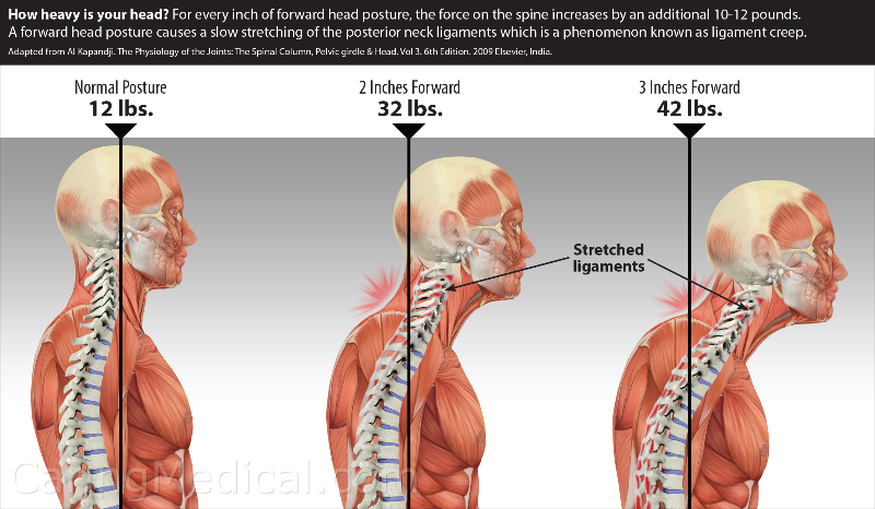 Why the Top of Your Spine Could Be the Key to Relieving Headaches and Migraines Naturally 4 Posture