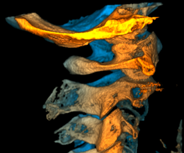 Dizziness & Vertigo: Understanding the Nervous System Connection 9 Spine Right 1